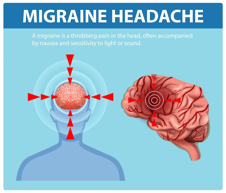 Vector gratuito comprender los síntomas de la migraña