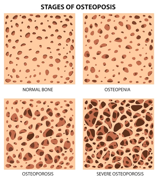 Vector gratuito etapas del vector de osteoposis