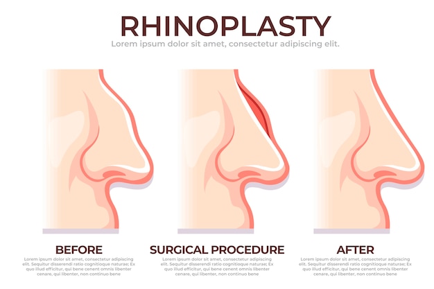Vector gratuito infografía de rinoplastia dibujada a mano