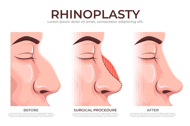 Vector gratuito infografía de rinoplastia dibujada a mano