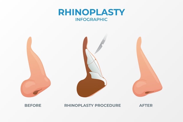 Vector gratuito infografía de rinoplastia en gradiente