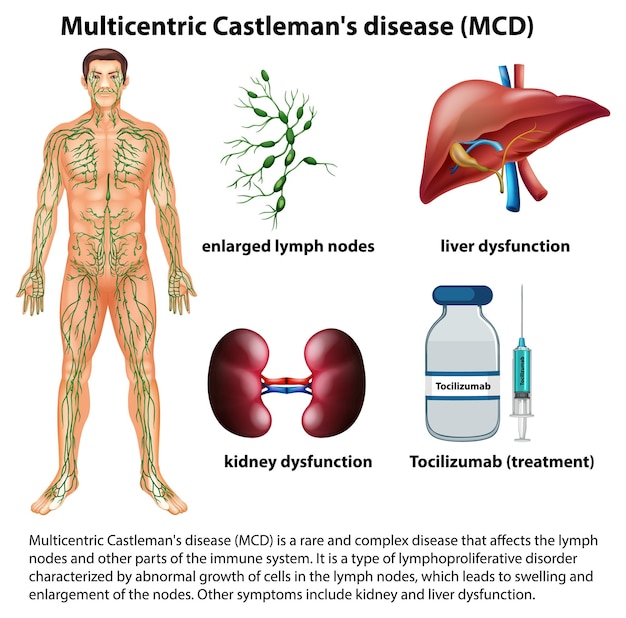 Miễn phí Vector bệnh castlemans đa trung tâm (mcd) - infographic