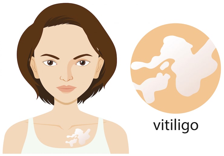 Miễn phí Vector người phụ nữ mắc bệnh bạch biến