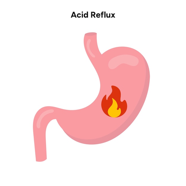 Vector reflujo ácido