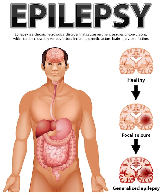 Gratis Vector informatieve poster over epilepsie