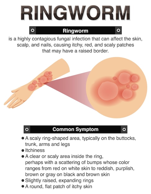 Gratis Vector informatieve symptomen van ringworm